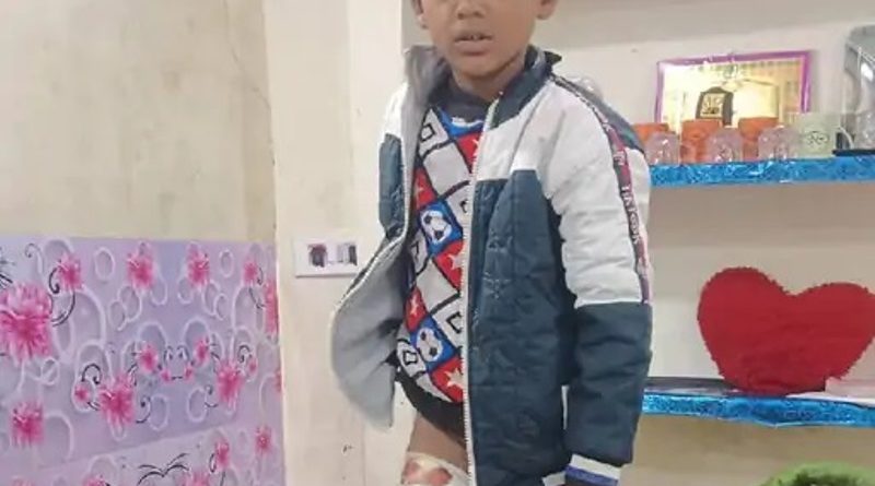 कोचिंग जा रहे 8 वर्षीय मासूम पर कुत्ते ने किया हमला, जांघ को जबड़े को दबाकर घसीटा, 10 दिन में 872 डॉग बाइट